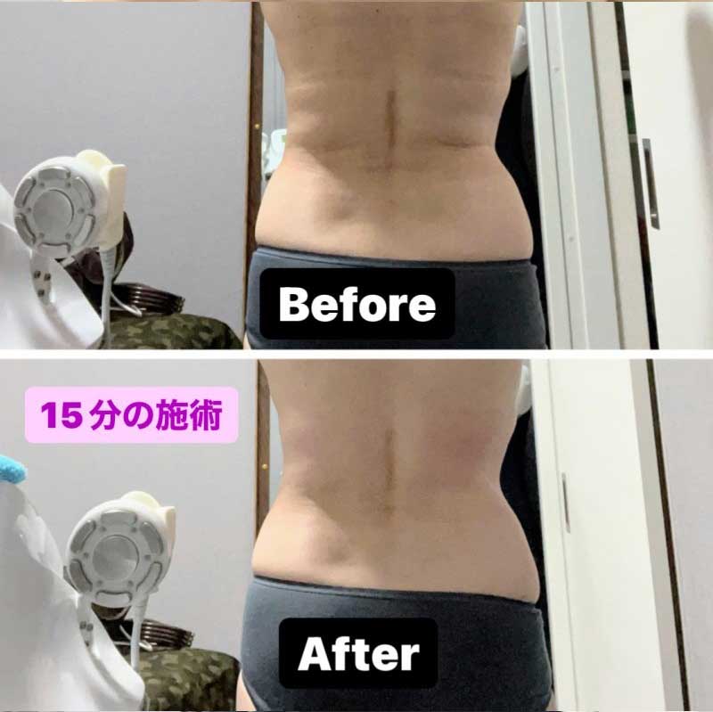 鴻巣の痩身エステのアフター写真